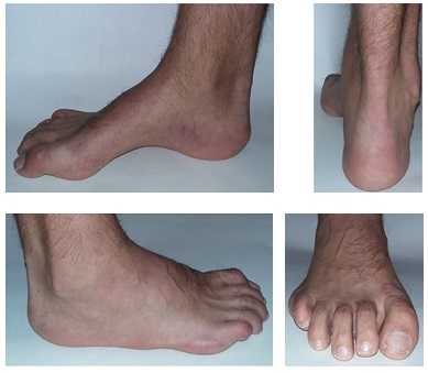 шарко мари тута