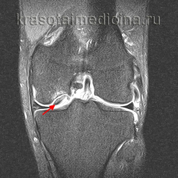 Рассекающий остеохондрит