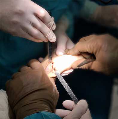 клиновидная остеотомия первой плюсневой кости