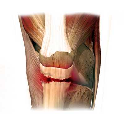 Операции на сухожилиях