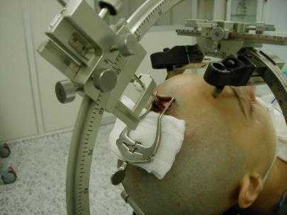 Операции на головном мозге 