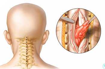 Под опухолями в позвоночнике понимают новообразования, которые возникают в клеточных структурах позвоночного столба. Они разрастаются внутрь спинного мозга, а также переходят на прилегающие ткани, вызывая характерные симптомы.