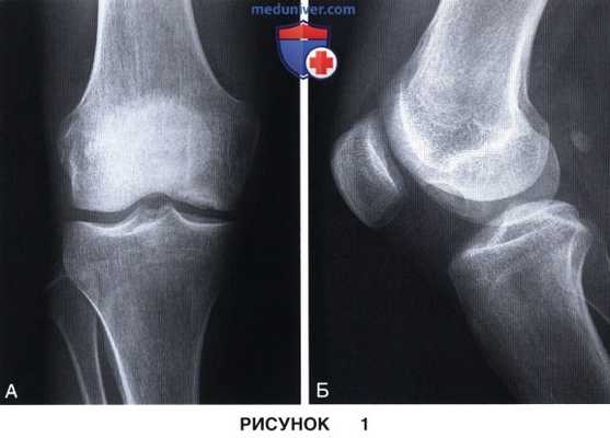 Показания и подготовка к операции при рассекающем остеохондрите коленного сустава
