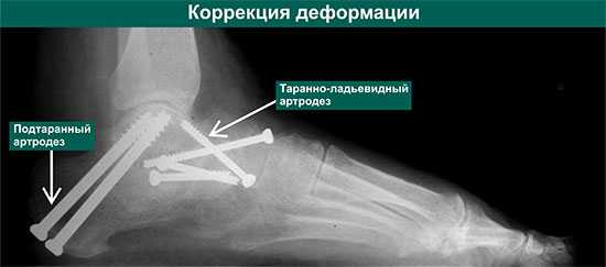 коррекция деформации