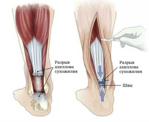 Разрыв сухожилия голени