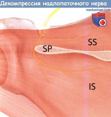 Декомпрессия надлопаточного нерва при нейропатии