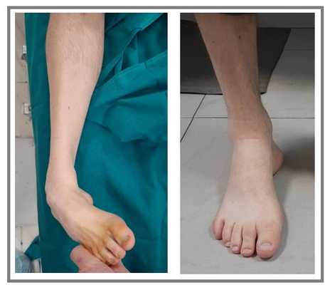 полая стопа