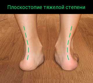 реконструкция стоп