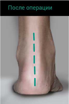 ДО АРТРОЭРЕЗА