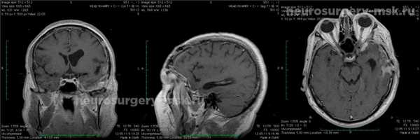 Менингиома средней черепной ямки (после операции)