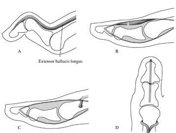молоткообразные пальцы