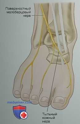 Артродез после неудачного тотального эндопротезирования голеностопного сустава (операция спасения)