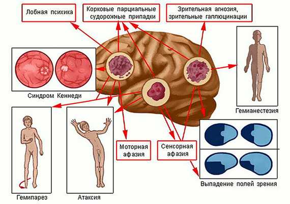 опухоль головного мозга операция в Москве