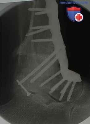 Операция при несостоятельности тотального эндопротеза голеностопного сустава (операции спасения)