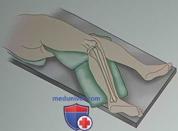 Операция при хроническом подвывихе и вывихе малоберцовых сухожилий