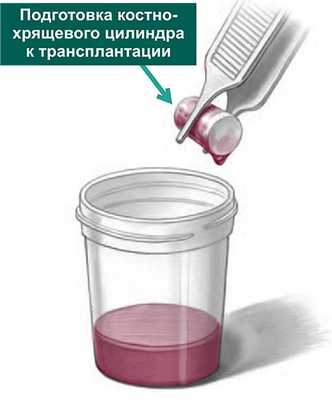 Подготовка костно-хрящевого цилиндра