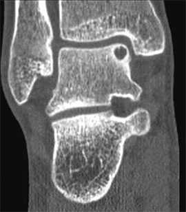 остеохондральные дефекты таранной кости