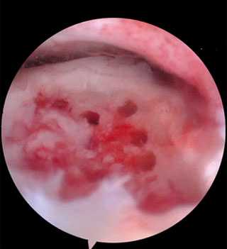 Артросокпический дебридмент