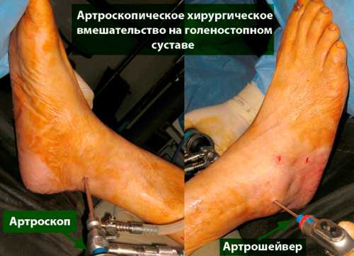 Артроскопия голеностопного сустава