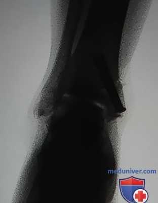 Остеохондральная аутотрансплантация при повреждении голеностопного сустава