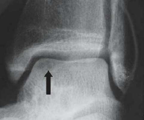 Ренгеновский снимок дефекта хряща таранной кости