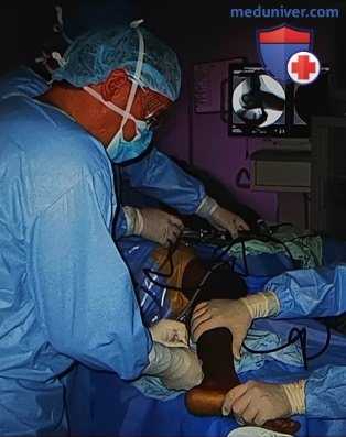 Остеохондральная аутотрансплантация при повреждении голеностопного сустава