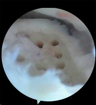 Артросокпический дебридмент и стимуляция костного мозга