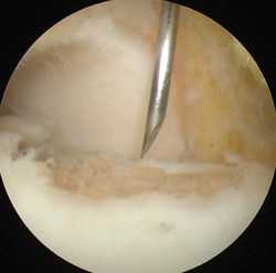 Артросокпическая обработка таранной кости