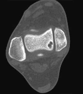 остеохондральные дефекты таранной кости КТ
