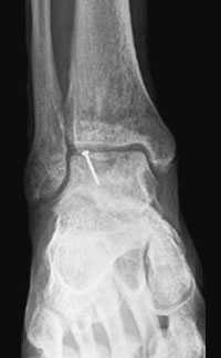 Рентген таранной кости