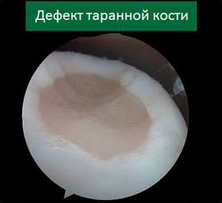 фото хрящевого дефекта