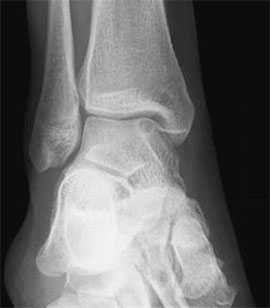 дефекты таранной кости КТ