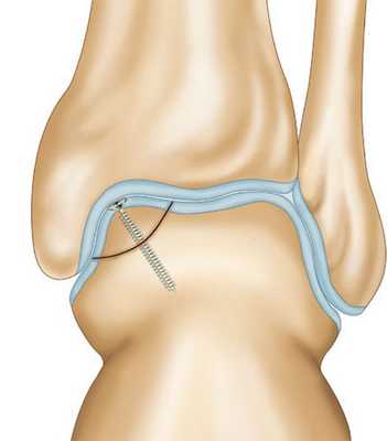 Фиксация крупного фрагмента винтом