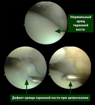 Повреждения хряща таранной кости