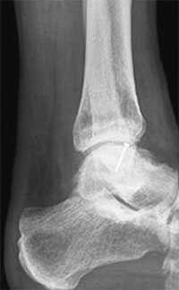 Рентген рефиксированного остеохондрального фрагмента таранной кости