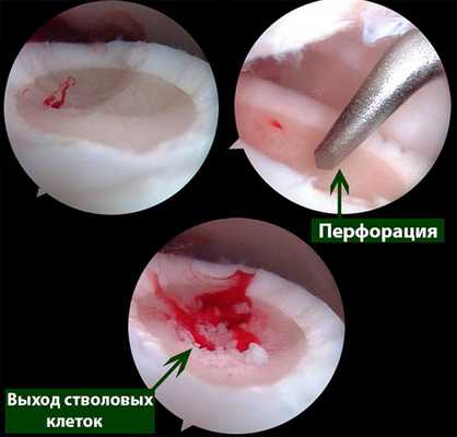артроскопический дебридмент
