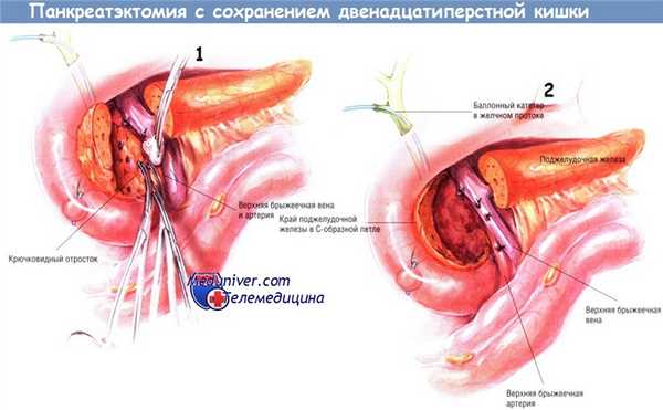 Методика операции панкреатэктомии с сохранением двенадцатиперстной кишки