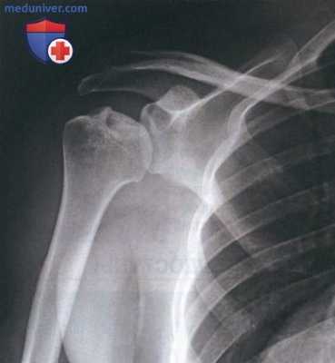 Операция поверхностного эндопротезирования головки плеча