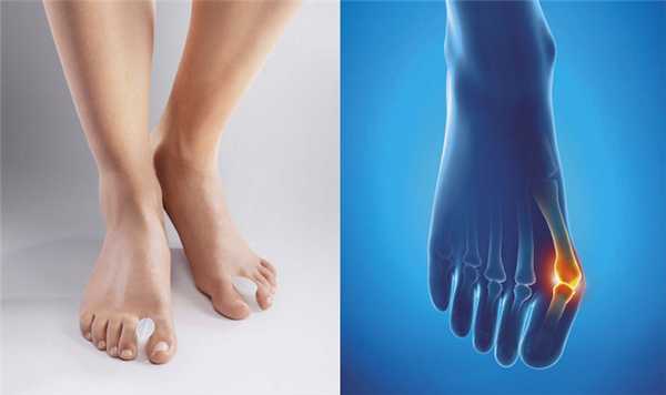Hallux valgus 