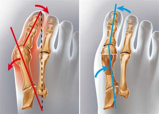 халюс вальгус