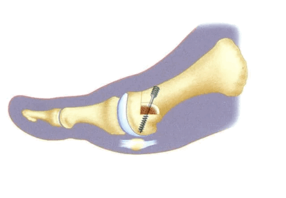 Операция халюс вальгус с винтами