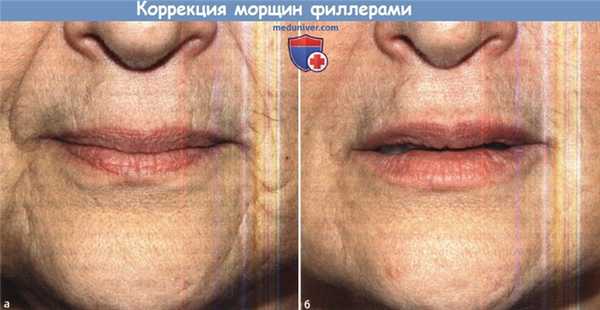 Коррекция морщин филлерами