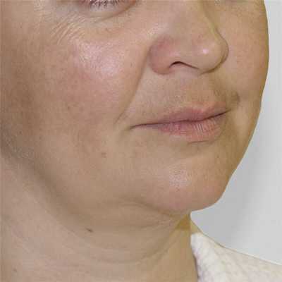 Лазерная липосакция подбородка до