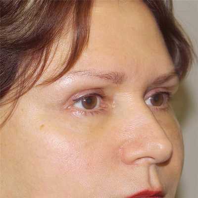 эндоскопическая подтяжка после