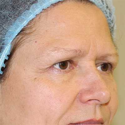 эндоскопическая подтяжка до