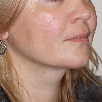 Лазерная липосакция подбородка после