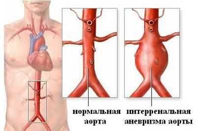 Аневризма брюшной аорты