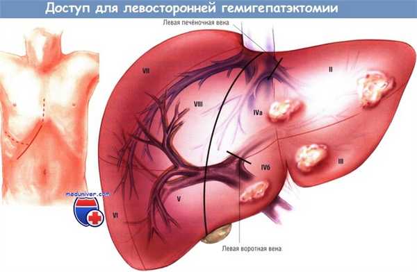 Доступ для левосторонней гемигепатэктомии