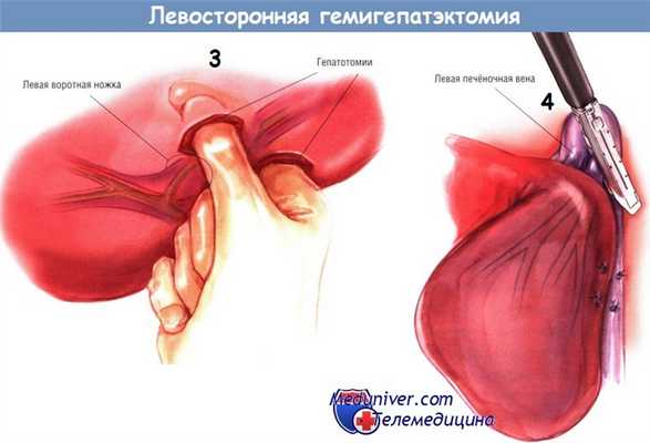 Ход операции левосторонней гемигепатэктомии