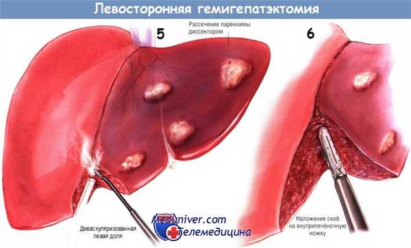 Ход операции левосторонней гемигепатэктомии